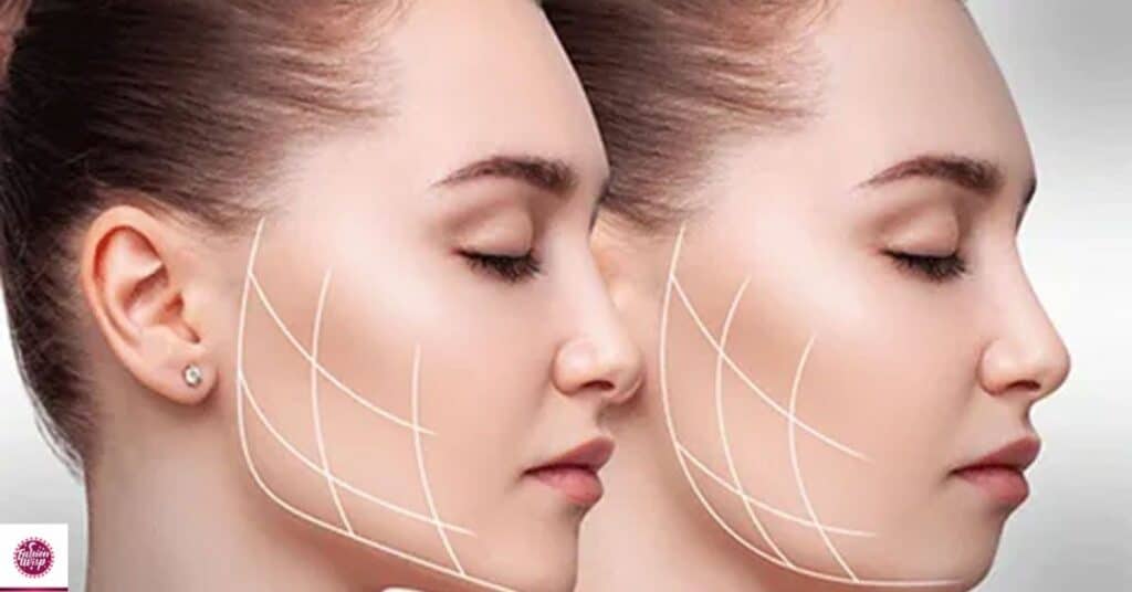 The Buccal Fat Removal Rumors: Dissecting the Alleged Cheekbone Enhancement